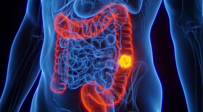 Ova tri “bezopasna” simptoma mogu ukazivati na rak debelog creva: Nisu pošteđeni ni mladi, a obično se pripisuju stresu Ova tri "bezopasna" simptoma mogu ukazivati na rak debelog creva: Nisu pošteđeni ni mladi, a obično se pripisuju stresu