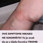 OVE SIMPTOME NIKAKO NE IGNORIŠITE! To je znak da se u tijelu formira TROMB opasan po ŽIVOT