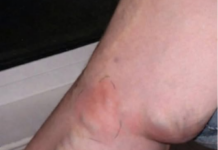 OVE SIMPTOME NIKAKO NE IGNORIŠITE! To je znak da se u tijelu formira TROMB opasan po ŽIVOT OVE SIMPTOME NIKAKO NE IGNORIŠITE! To je znak da se u tijelu formira TROMB opasan po ŽIVOT