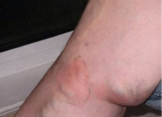 OVE SIMPTOME NIKAKO NE IGNORIŠITE! To je znak da se u tijelu formira TROMB opasan po ŽIVOT OVE SIMPTOME NIKAKO NE IGNORIŠITE! To je znak da se u tijelu formira TROMB opasan po ŽIVOT