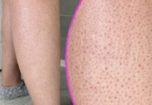 OVE TAČKICE NA NOGAMA VAM KVARE LJETO? Evo kako da ih se riješite, koža će vam biti glatka OVE TAČKICE NA NOGAMA VAM KVARE LJETO? Evo kako da ih se riješite, koža će vam biti glatka