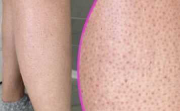 OVE TAČKICE NA NOGAMA VAM KVARE LJETO? Evo kako da ih se riješite, koža će vam biti glatka OVE TAČKICE NA NOGAMA VAM KVARE LJETO? Evo kako da ih se riješite, koža će vam biti glatka