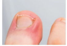 PAZITE SE! Ako nokti pokažu ovaj znak, idite odmah kod ljekara: Upozorenje na PROBLEM koji može biti OZBILJAN PAZITE SE! Ako nokti pokažu ovaj znak, idite odmah kod ljekara: Upozorenje na PROBLEM koji može biti OZBILJAN