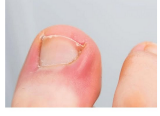 PAZITE SE! Ako nokti pokažu ovaj znak, idite odmah kod ljekara: Upozorenje na PROBLEM koji može biti OZBILJAN PAZITE SE! Ako nokti pokažu ovaj znak, idite odmah kod ljekara: Upozorenje na PROBLEM koji može biti OZBILJAN