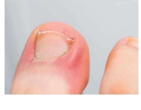 PAZITE SE! Ako nokti pokažu ovaj znak, idite odmah kod ljekara: Upozorenje na PROBLEM koji može biti OZBILJAN PAZITE SE! Ako nokti pokažu ovaj znak, idite odmah kod ljekara: Upozorenje na PROBLEM koji može biti OZBILJAN