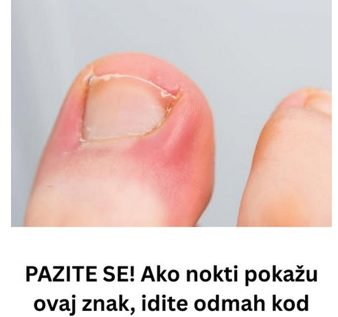 PAZITE SE! Ako nokti pokažu ovaj znak, idite odmah kod ljekara: Upozorenje na PROBLEM koji može biti OZBILJAN PAZITE SE! Ako nokti pokažu ovaj znak, idite odmah kod ljekara: Upozorenje na PROBLEM koji može biti OZBILJAN