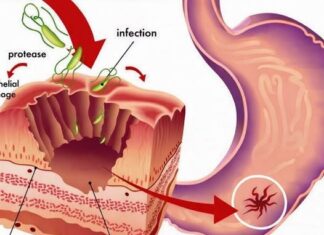 TAKO JE JEDNOSTAVNO, A NISMO ZNALI: Prirodan način uklanjanja BAKTERIJA u ŽELUCU i to za 2 DANA! TAKO JE JEDNOSTAVNO, A NISMO ZNALI: Prirodan način uklanjanja BAKTERIJA u ŽELUCU i to za 2 DANA!