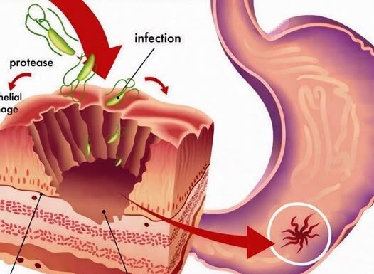 TAKO JE JEDNOSTAVNO, A NISMO ZNALI: Prirodan način uklanjanja BAKTERIJA u ŽELUCU i to za 2 DANA! TAKO JE JEDNOSTAVNO, A NISMO ZNALI: Prirodan način uklanjanja BAKTERIJA u ŽELUCU i to za 2 DANA!