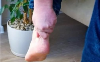 3 ZNAKA VISOKOG HOLESTEROLA: Odmah pogledajte vaše ruke i noge 3 ZNAKA VISOKOG HOLESTEROLA: Odmah pogledajte vaše ruke i noge