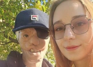 Igor je imao 7 godina kad ga je majka ostavila sa stafordom koji ga je napao i odgrizao pola lica: 25 godina kasnije, život mu je tuga Igor je imao 7 godina kad ga je majka ostavila sa stafordom koji ga je napao i odgrizao pola lica: 25 godina kasnije, život mu je tuga