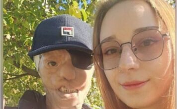 Igor je imao 7 godina kad ga je majka ostavila sa stafordom koji ga je napao i odgrizao pola lica: 25 godina kasnije, život mu je tuga Igor je imao 7 godina kad ga je majka ostavila sa stafordom koji ga je napao i odgrizao pola lica: 25 godina kasnije, život mu je tuga