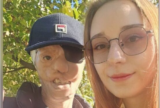 Igor je imao 7 godina kad ga je majka ostavila sa stafordom koji ga je napao i odgrizao pola lica: 25 godina kasnije, život mu je tuga Igor je imao 7 godina kad ga je majka ostavila sa stafordom koji ga je napao i odgrizao pola lica: 25 godina kasnije, život mu je tuga