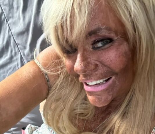 Nakon opsesije za preplanulim tenom bacila se na botoks: Ćerku od 5 godina vodila u solarijum da dobije boju Nakon opsesije za preplanulim tenom bacila se na botoks: Ćerku od 5 godina vodila u solarijum da dobije boju