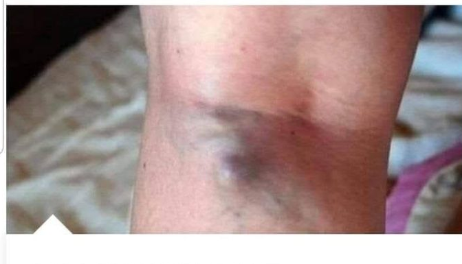 NAMIRNICE KOJE POVEĆAVAJU RIZIK OD TROMBOZE, JEDNA POSEBNO: Jedemo ih svakoga dana, a štete arterijama NAMIRNICE KOJE POVEĆAVAJU RIZIK OD TROMBOZE, JEDNA POSEBNO: Jedemo ih svakoga dana, a štete arterijama