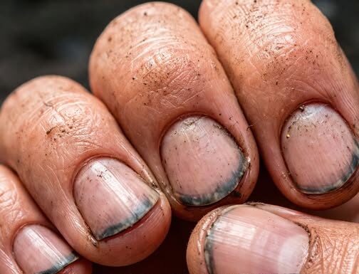 Prsti sa prljavim noktima: znak zapuštenosti ili dokaz napornog rada Prsti sa prljavim noktima: znak zapuštenosti ili dokaz napornog rada