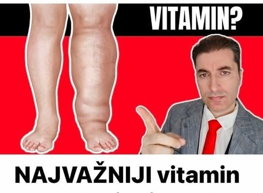 NAJVAŽNIJI vitamin za otklanjanje otoka ruku, nogu i stopala! NAJVAŽNIJI vitamin za otklanjanje otoka ruku, nogu i stopala!