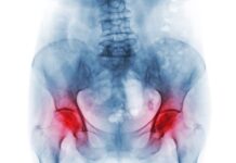 Ova 4 rana simptoma osteoporoze ne smete zanemariti: Zovu je “tiha bolest”, a može biti pogubna za žene preko 50 godina Ova 4 rana simptoma osteoporoze ne smete zanemariti: Zovu je "tiha bolest", a može biti pogubna za žene preko 50 godina