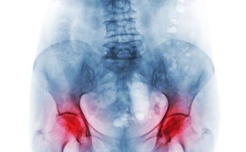 Ova 4 rana simptoma osteoporoze ne smete zanemariti: Zovu je “tiha bolest”, a može biti pogubna za žene preko 50 godina Ova 4 rana simptoma osteoporoze ne smete zanemariti: Zovu je "tiha bolest", a može biti pogubna za žene preko 50 godina
