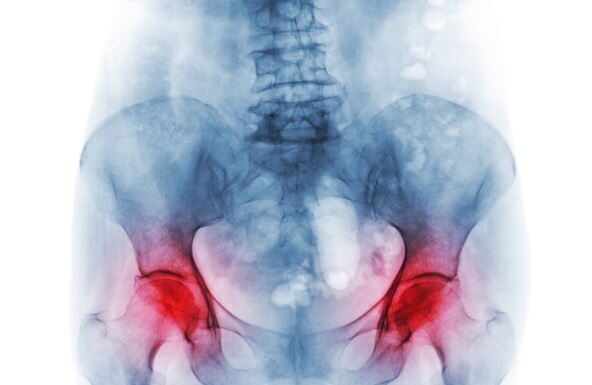 Ova 4 rana simptoma osteoporoze ne smete zanemariti: Zovu je “tiha bolest”, a može biti pogubna za žene preko 50 godina Ova 4 rana simptoma osteoporoze ne smete zanemariti: Zovu je "tiha bolest", a može biti pogubna za žene preko 50 godina