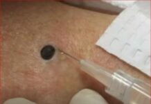 ŽENA JE GAJILA OVO NA LEĐIMA: Kada je doktorka uzela špric i bocnula, shvatit ćete zašto je SNIMAK pregledalo 33 miliona ljudi! ŽENA JE GAJILA OVO NA LEĐIMA: Kada je doktorka uzela špric i bocnula, shvatit ćete zašto je SNIMAK pregledalo 33 miliona ljudi!