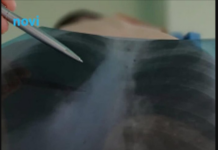 Otišao na rendgen pluća, šokirao doktore: Nisu mogli vjerovati što se nalazilo u njegovim prsima Otišao na rendgen pluća, šokirao doktore: Nisu mogli vjerovati što se nalazilo u njegovim prsima