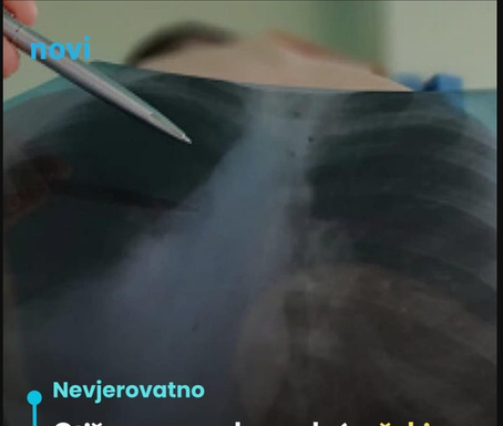Otišao na rendgen pluća, šokirao doktore: Nisu mogli vjerovati što se nalazilo u njegovim prsima Otišao na rendgen pluća, šokirao doktore: Nisu mogli vjerovati što se nalazilo u njegovim prsima