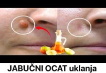 JABUČNI OCAT uklanja BRADAVICE za 24 SATA! Samo napravite ovo! JABUČNI OCAT uklanja BRADAVICE za 24 SATA! Samo napravite ovo!