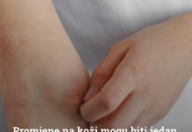 Promjene na koži mogu biti jedan od prvih znakova dijabetesa: Ovih osam simptoma nikada nemojte ignorirati Promjene na koži mogu biti jedan od prvih znakova dijabetesa: Ovih osam simptoma nikada nemojte ignorirati