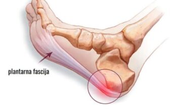 Šta je plantarni fascitis petni trn Šta je plantarni fascitis petni trn