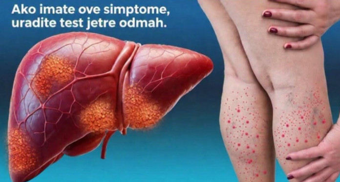 DA LI JE VAŠA JETRA U OPASNOSTI? Ovo je 12 ranih znakova ciroze jetre koje ne smete da ignorišete DA LI JE VAŠA JETRA U OPASNOSTI? Ovo je 12 ranih znakova ciroze jetre koje ne smete da ignorišete