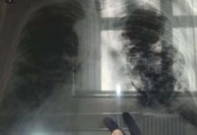 OVO JE PRVI SIMPTOM RAKA PLUĆA, A NIJE KAŠALJ: Većina ljudi ga nikad ne poveže sa ovom opakom bolešću! OVO JE PRVI SIMPTOM RAKA PLUĆA, A NIJE KAŠALJ: Većina ljudi ga nikad ne poveže sa ovom opakom bolešću!