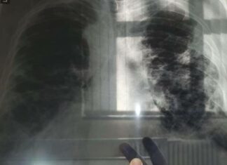 OVO JE PRVI SIMPTOM RAKA PLUĆA, A NIJE KAŠALJ: Većina ljudi ga nikad ne poveže sa ovom opakom bolešću! OVO JE PRVI SIMPTOM RAKA PLUĆA, A NIJE KAŠALJ: Većina ljudi ga nikad ne poveže sa ovom opakom bolešću!