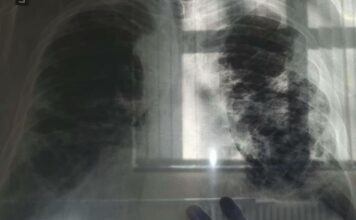 OVO JE PRVI SIMPTOM RAKA PLUĆA, A NIJE KAŠALJ: Većina ljudi ga nikad ne poveže sa ovom opakom bolešću! OVO JE PRVI SIMPTOM RAKA PLUĆA, A NIJE KAŠALJ: Većina ljudi ga nikad ne poveže sa ovom opakom bolešću!